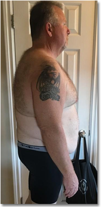 John 2 months out from Gastric Surgery