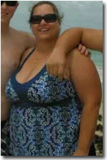 Weight Loss Surgery Patient Before and After