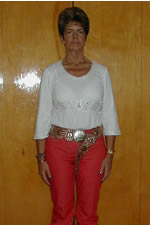 Alice 2 Years After Gastric Bypass