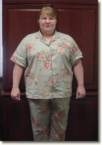 Eumlema before bariatric surgery