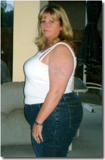 Julie Hudson Before Lap Band Surgery