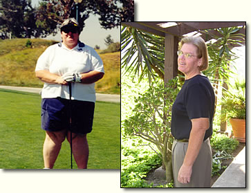 Nancy Before and After Surgery